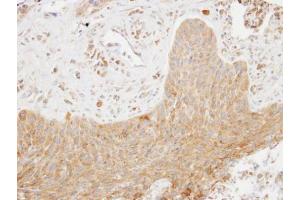 IHC-P Image Immunohistochemical analysis of paraffin-embedded human lung cancer, using SCAP2, antibody at 1:100 dilution. (SKAP2 anticorps  (C-Term))