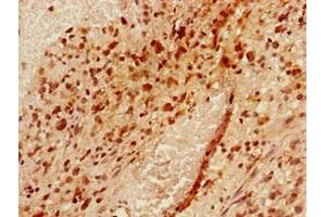 Immunohistochemistry of paraffin-embedded human glioma using ABIN7175954 at dilution of 1:100 (YAF2 anticorps  (AA 1-204))