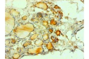 Immunohistochemical of paraffin-embedded human thyroid tissues using ABIN7162718 at dilution of 1:200 (CGRP anticorps)