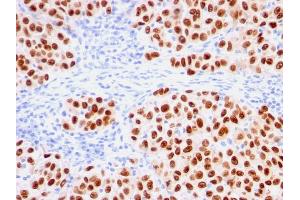Formalin-fixed, paraffin-embedded human melanoma stained with SOX10-Monospecific Recombinant Mouse Monoclonal Antibody (rSOX10/1074). (Recombinant SOX10 anticorps  (AA 115-269))