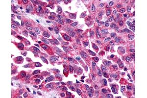 Anti-FZD8 / Frizzled 8 antibody IHC of human Lung, Non-Small Cell Carcinoma.