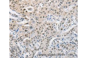 Immunohistochemistry of Human cervical cancer using CDC27 Polyclonal Antibody at dilution of 1:50 (CDC27 anticorps)