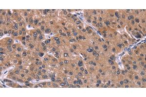 Immunohistochemistry of paraffin-embedded Human prostate cancer tissue using HSD11B2 Polyclonal Antibody at dilution 1:35 (HSD11B2 anticorps)