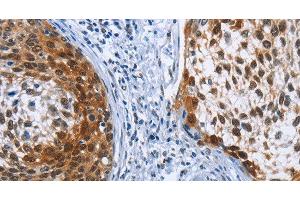 Immunohistochemistry of paraffin-embedded Human cervical cancer tissue using CRABP2 Polyclonal Antibody at dilution 1:40 (CRABP2 anticorps)