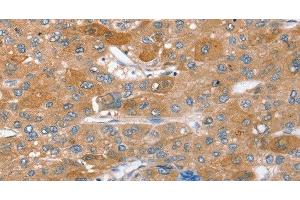 Immunohistochemistry of paraffin-embedded Human liver cancer using STX2 Polyclonal Antibody at dilution of 1:40 (STX2 anticorps)