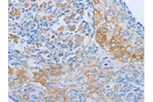 The image on the left is immunohistochemistry of paraffin-embedded Human cervical cancer tissue using ABIN7189704(ADRB3 Antibody) at dilution 1/60, on the right is treated with synthetic peptide. (ADRB3 anticorps)