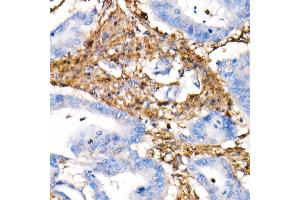 Immunohistochemistry of paraffin-embedded Human colon carcinoma using Vimentin antibody (ABIN7271326) at dilution of 1:100 (40x lens).