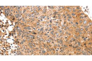 Immunohistochemistry of paraffin-embedded Human esophagus cancer tissue using ABCC9 Polyclonal Antibody at dilution 1:50 (ABCC9 anticorps)
