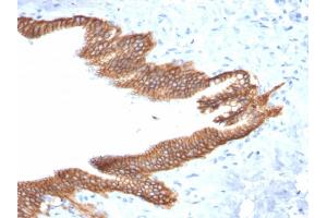 Formalin-fixed, paraffin-embedded human Pancreatic Carcinoma stained with TACSTD2 / TROP2 Mouse Monoclonal Antibody (TACSTD2/2152). (TACSTD2 anticorps  (AA 31-274))