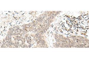 Immunohistochemistry of paraffin-embedded Human esophagus cancer tissue using FAM84B Polyclonal Antibody at dilution of 1:70(x200) (FAM84B anticorps)