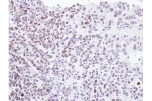 IHC-P Image Immunohistochemical analysis of paraffin-embedded SW480 xenograft , using Homeobox-containing protein 1, antibody at 1:500 dilution. (HMBOX1 anticorps)