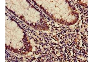 Immunohistochemistry of paraffin-embedded human colon cancer using ABIN7158683 at dilution of 1:100 (KARS anticorps  (AA 101-400))