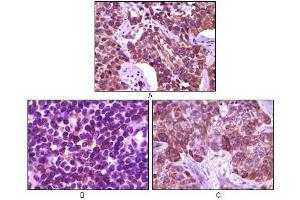 Immunohistochemical analysis of paraffin-embedded human lung carcinoma (A), lymph tissue (B) and skin carcinoma (C), showing membrane localization using BLK antibody with DAB staining. (BLK anticorps)