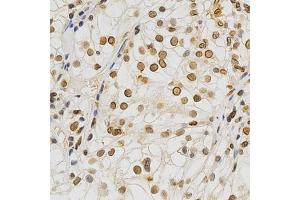 Immunohistochemistry of paraffin-embedded human kidney cancer using Lamin A/C antibody. (Lamin A/C anticorps)