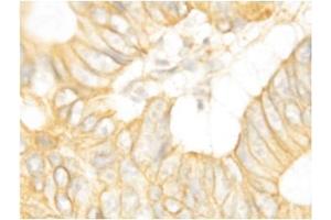 Immunohistochemical staining of Human Intestines Cancer (FGFR2 anticorps  (C-Term))