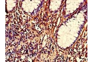 Immunohistochemistry of paraffin-embedded human colon cancer using ABIN7161922 at dilution of 1:100 (NRIP2 anticorps  (AA 1-281))
