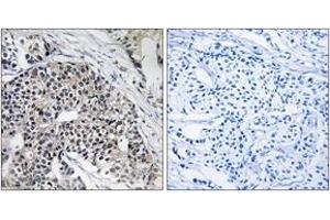 Immunohistochemistry analysis of paraffin-embedded human breast carcinoma tissue, using MRPL24 Antibody. (MRPL24 anticorps  (AA 101-150))
