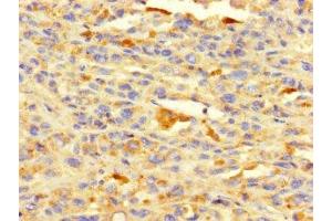 Immunohistochemistry of paraffin-embedded human melanoma using ABIN7155301 at dilution of 1:100