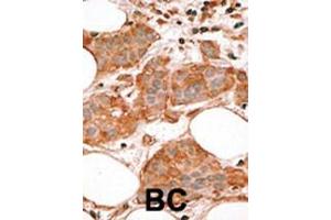 Formalin-fixed and paraffin-embedded human cancer tissue reacted with the primary antibody, which was peroxidase-conjugated to the secondary antibody, followed by AEC staining. (BCL2L14 anticorps  (AA 194-229))