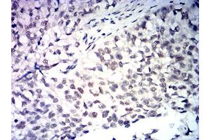 Immunohistochemical analysis of paraffin-embedded bladder cancer tissues using MDM2 mouse mAb with DAB staining. (MDM2 anticorps  (AA 26-169))