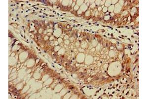 Immunohistochemistry of paraffin-embedded human colon cancer using ABIN7150558 at dilution of 1:100 (DNAJC4 anticorps  (AA 1-155))