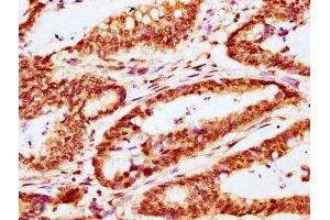 IHC image of ABIN7146274 diluted at 1:400 and staining in paraffin-embedded human colon cancer performed on a Leica BondTM system.