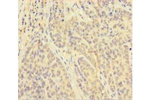 Immunohistochemistry of paraffin-embedded human ovarian cancer using ABIN7162611 at dilution of 1:100