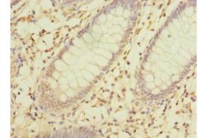 Immunohistochemistry of paraffin-embedded human colon cancer using ABIN7142357 at dilution of 1:100 (MRPL16 anticorps  (AA 37-251))