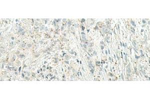 Immunohistochemistry of paraffin-embedded Human breast cancer tissue using UQCC2 Polyclonal Antibody at dilution of 1:60(x200) (MNF1 anticorps)