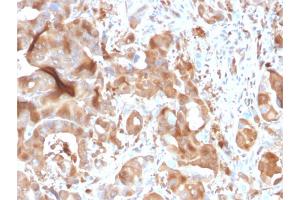 Formalin-fixed, paraffin-embedded human Hepatic Carcinoma stained with FABP5 Mouse Monoclonal Antibody (CPTC-FABP5-3). (FABP5 anticorps)