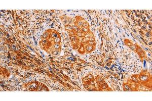 Immunohistochemistry of paraffin-embedded Human cervical cancer using SLC25A4 Polyclonal Antibody at dilution of 1:40 (SLC25A4 anticorps)