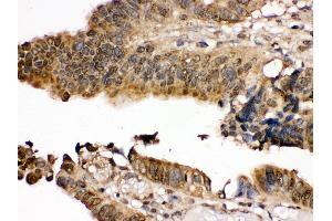 IHC(P): Human Intestinal Cancer Tissue