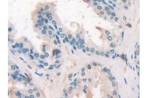 Detection of SOCS2 in Human Prostate Tissue using Polyclonal Antibody to Suppressors Of Cytokine Signaling 2 (SOCS2)