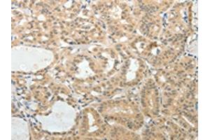 The image on the left is immunohistochemistry of paraffin-embedded Human thyroid cancer tissue using ABIN7189710(AFF2 Antibody) at dilution 1/25, on the right is treated with synthetic peptide. (AFF2 anticorps)