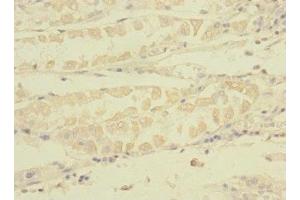 Immunohistochemistry of paraffin-embedded human gastric cancer using  at dilution of 1:100 (TNRC6A anticorps  (AA 1-161))
