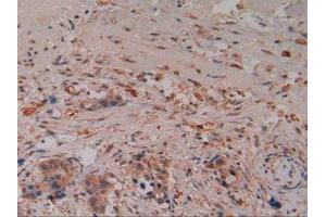 IHC-P analysis of Human Pancreas Cancer Tissue, with DAB staining. (Caspase 8 anticorps  (AA 7-216))