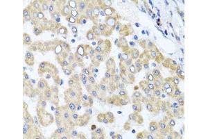 Immunohistochemistry of paraffin-embedded Human liver damage using RAB24 Polyclonal Antibody at dilution of 1:100 (40x lens). (RAB24 anticorps)