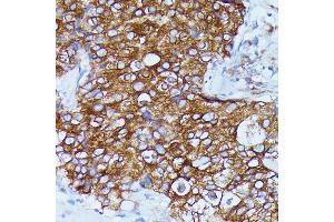 Immunohistochemistry of paraffin-embedded human mammary cancer using DDX6 antibody (ABIN7266704) at dilution of 1:100 (40x lens). (DDX6 anticorps  (C-Term))