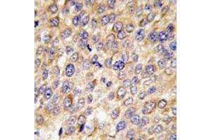 IHC analysis of FFPE human hepatocarcinoma tissue stained with GABARAP antibody (GABARAP anticorps  (AA 1-30))