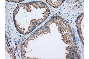Immunohistochemical staining of paraffin-embedded Adenocarcinoma of Human ovary tissue using anti-TTC32 mouse monoclonal antibody. (TTC32 anticorps)
