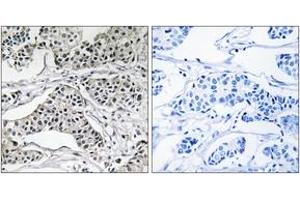 Immunohistochemistry analysis of paraffin-embedded human breast carcinoma tissue, using PLD3 Antibody. (PLD3 anticorps  (AA 326-375))