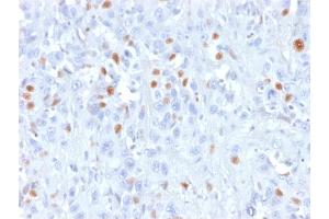 Formalin-fixed, paraffin-embedded human Urothelial carcinoma stained with p21 Mouse Recombinant Monoclonal Antibody (rCIP1/823). (Recombinant p21 anticorps)