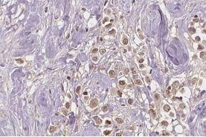ABIN6267274 at 1/100 staining human breast carcinoma tissue sections by IHC-P.