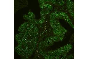 IF analysis of PHF21A using anti-PHF21A antibody (ABIN6719353) PHF21A was detected in paraffin-embedded section of human intestinal cancer tissues. (PHF21A anticorps  (AA 1-97))