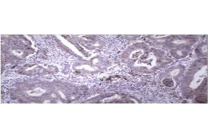 Immunohistochemical staining of paraffin embedded colon carcinoma using MMP9 antibody . (MMP 9 anticorps  (C-Term))