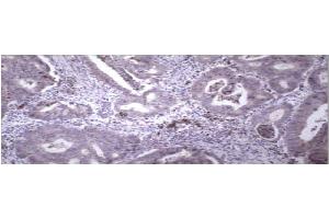 Immunohistochemical staining of paraffin embedded colon carcinoma using MMP9 antibody .