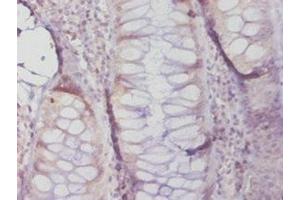 Immunohistochemistry of paraffin-embedded human colon cancer using ABIN7159622 at dilution of 1:20