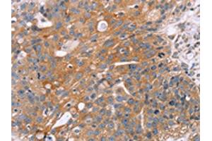 The image on the left is immunohistochemistry of paraffin-embedded Human breast cancer tissue using ABIN7130502(OPTN Antibody) at dilution 1/25, on the right is treated with fusion protein. (OPTN anticorps)