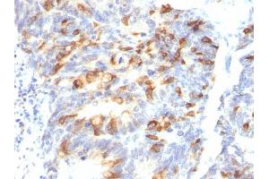 Formalin-fixed, paraffin-embedded human Colon Carcinoma stained with MUC2 Mouse Monoclonal Antibody (MLP/842).