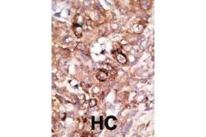 Formalin-fixed and paraffin-embedded human cancer tissue reacted with the primary antibody, which was peroxidase-conjugated to the secondary antibody, followed by AEC staining. (BAD anticorps  (AA 92-127))